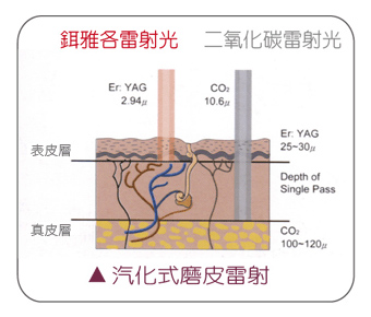 鉺雅鉻磨皮雷射