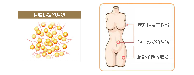 抽脂隆乳,自體脂肪移植隆乳,自體脂肪移植豐胸,自體脂肪移植豐頰,自體脂肪補淚溝,自體脂肪豐唇,自體脂肪豐下巴,自體脂肪豐太陽穴,自體脂肪豐臀