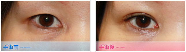 隆鼻,雙眼皮,眼睛整形,割雙眼皮,縫雙眼皮,雙眼皮手術,開眼頭