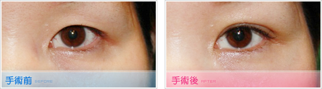 隆鼻,雙眼皮,眼睛整形,割雙眼皮,縫雙眼皮,雙眼皮手術,開眼頭