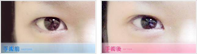 隆鼻,雙眼皮,眼睛整形,割雙眼皮,縫雙眼皮,雙眼皮手術,開眼頭