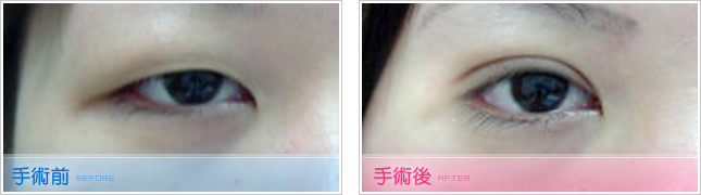隆鼻,雙眼皮,眼睛整形,割雙眼皮,縫雙眼皮,雙眼皮手術,開眼頭