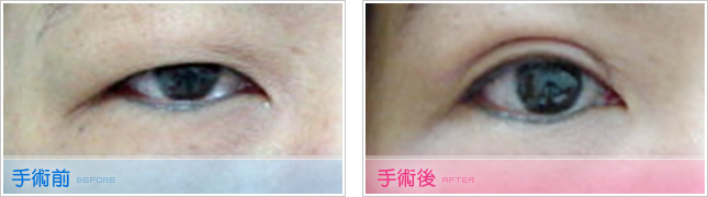 隆鼻,雙眼皮,眼睛整形,割雙眼皮,縫雙眼皮,雙眼皮手術,開眼頭