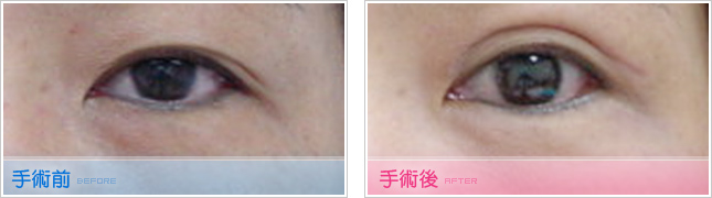 隆鼻,雙眼皮,眼睛整形,割雙眼皮,縫雙眼皮,雙眼皮手術,開眼頭