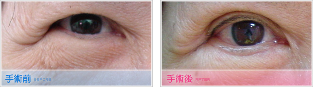 隆鼻,雙眼皮,眼睛整形,割雙眼皮,縫雙眼皮,雙眼皮手術,開眼頭