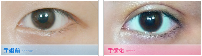 隆鼻,雙眼皮,眼睛整形,割雙眼皮,縫雙眼皮,雙眼皮手術,開眼頭