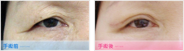 隆鼻,雙眼皮,眼睛整形,割雙眼皮,縫雙眼皮,雙眼皮手術,開眼頭