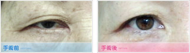 隆鼻,雙眼皮,眼睛整形,割雙眼皮,縫雙眼皮,雙眼皮手術,開眼頭
