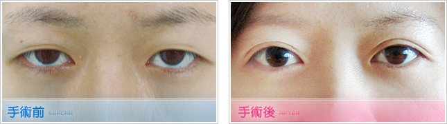 隆鼻,雙眼皮,眼睛整形,割雙眼皮,縫雙眼皮,雙眼皮手術,開眼頭