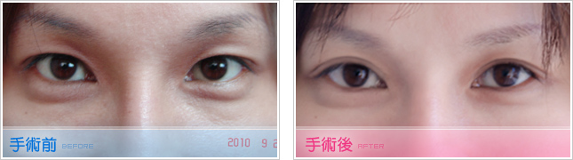 隆鼻,雙眼皮,眼睛整形,割雙眼皮,縫雙眼皮,雙眼皮手術,開眼頭