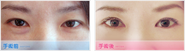 隆鼻,雙眼皮,眼睛整形,割雙眼皮,縫雙眼皮,雙眼皮手術,開眼頭