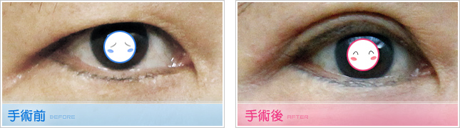 隆鼻,雙眼皮,眼睛整形,割雙眼皮,縫雙眼皮,雙眼皮手術,開眼頭