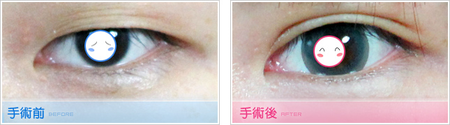 隆鼻,雙眼皮,眼睛整形,割雙眼皮,縫雙眼皮,雙眼皮手術,開眼頭