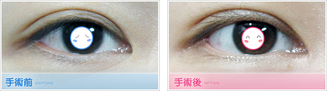隆鼻,雙眼皮,眼睛整形,割雙眼皮,縫雙眼皮,雙眼皮手術,開眼頭