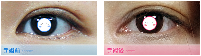隆鼻,雙眼皮,眼睛整形,割雙眼皮,縫雙眼皮,雙眼皮手術,開眼頭