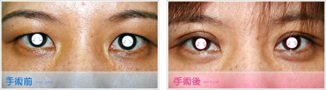 隆鼻,雙眼皮,眼睛整形,割雙眼皮,縫雙眼皮,雙眼皮手術,開眼頭