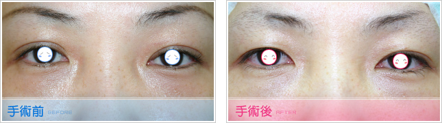 隆鼻,雙眼皮,眼睛整形,割雙眼皮,縫雙眼皮,雙眼皮手術,開眼頭