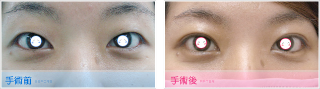 隆鼻,雙眼皮,眼睛整形,割雙眼皮,縫雙眼皮,雙眼皮手術,開眼頭
