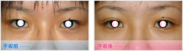 隆鼻,雙眼皮,眼睛整形,割雙眼皮,縫雙眼皮,雙眼皮手術,開眼頭