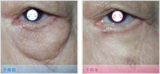 眼袋,填淚溝,眼袋脂肪回推,去眼袋,去除眼袋,割眼袋,眼袋整形,眼袋手術