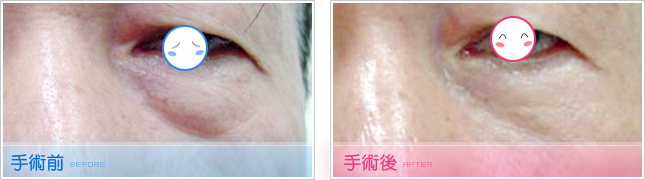 眼袋,填淚溝,眼袋脂肪回推,去眼袋,去除眼袋,割眼袋,眼袋整形,眼袋手術