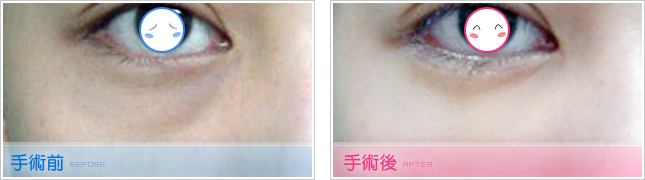 眼袋,填淚溝,眼袋脂肪回推,去眼袋,去除眼袋,割眼袋,眼袋整形,眼袋手術