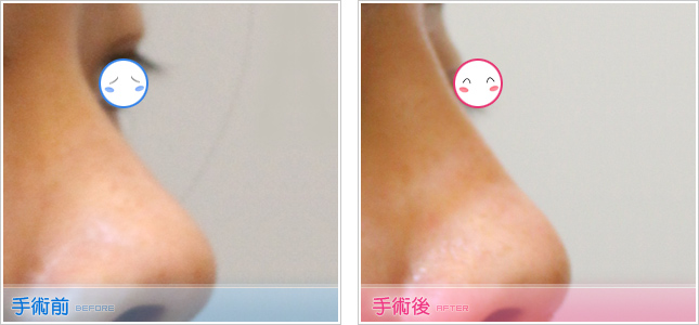 抽脂隆乳,自體脂肪移植隆乳,自體脂肪移植豐胸,自體脂肪移植豐頰,自體脂肪補淚溝,自體脂肪豐唇,自體脂肪豐下巴,自體脂肪豐太陽穴,自體脂肪豐臀
