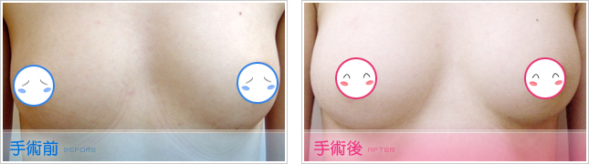 抽脂隆乳,自體脂肪移植隆乳,自體脂肪移植豐胸,自體脂肪移植豐頰,自體脂肪補淚溝,自體脂肪豐唇,自體脂肪豐下巴,自體脂肪豐太陽穴,自體脂肪豐臀