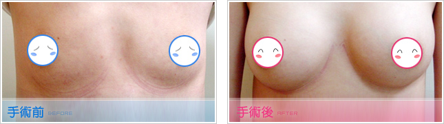 抽脂隆乳,自體脂肪移植隆乳,自體脂肪移植豐胸,自體脂肪移植豐頰,自體脂肪補淚溝,自體脂肪豐唇,自體脂肪豐下巴,自體脂肪豐太陽穴,自體脂肪豐臀
